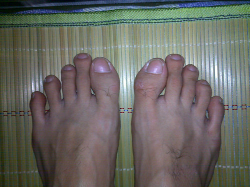 有木有谁的脚指头是这样的?